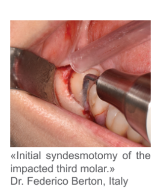 Initial syndesmotomy of the impacted third molar by Dr. Federico Berton, Italy