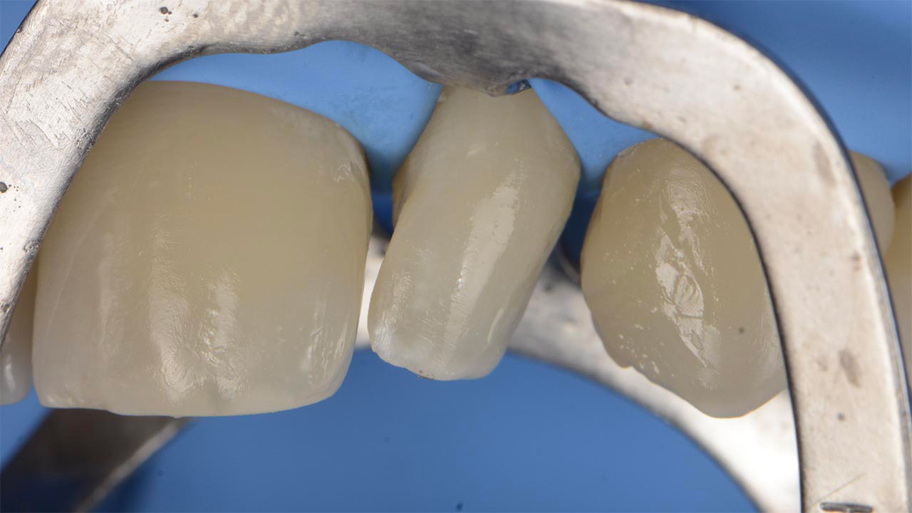 3M™ Filtek™ Easy Match Universal Restorative is used to contour