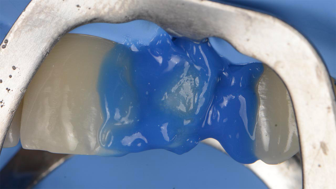 The preparation and proximal aspects of the adjacent teeth