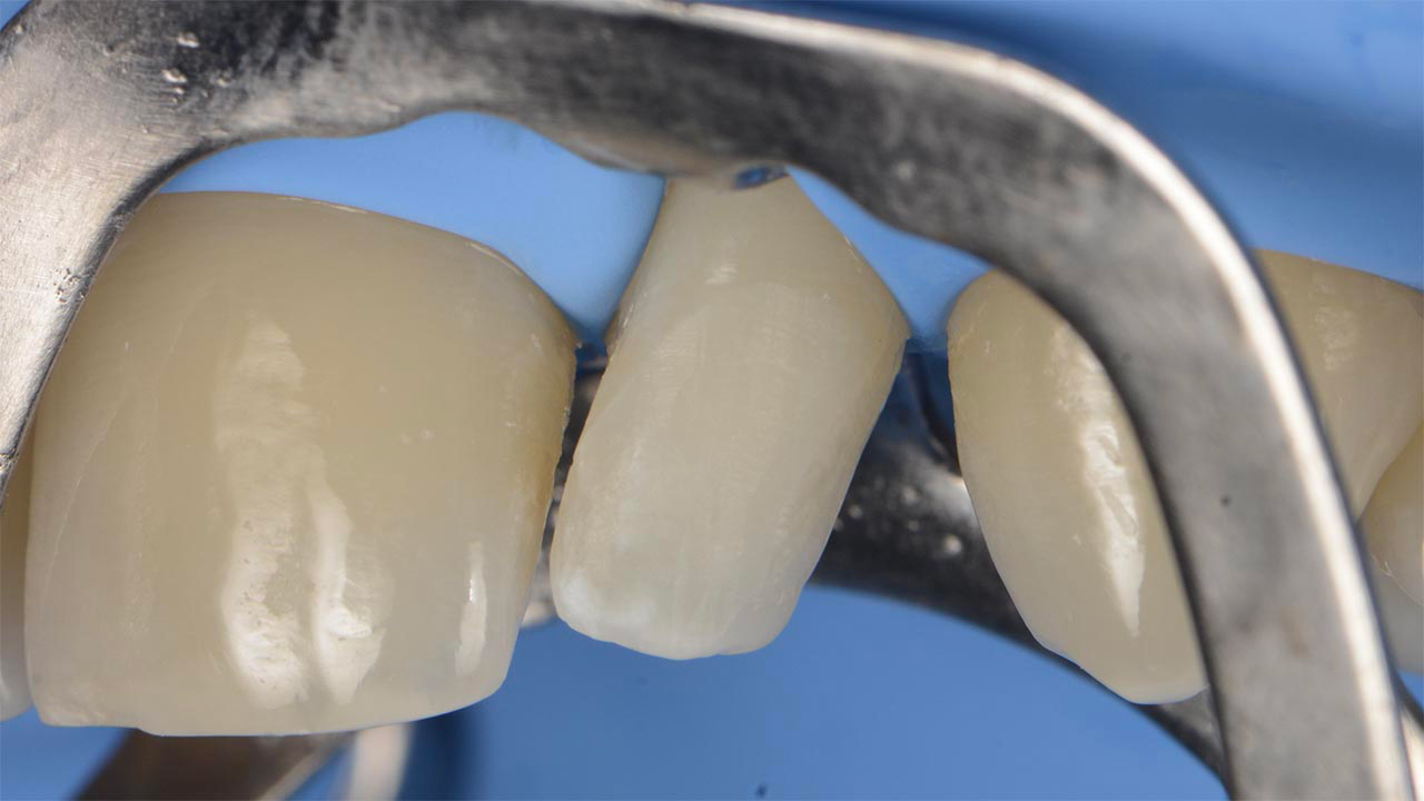 After isolation and retraction