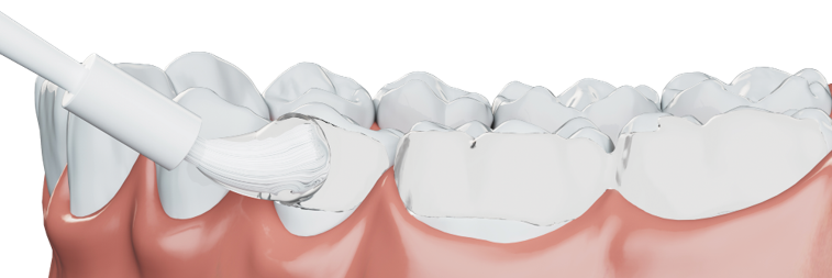 Clinpro™ Clear Fluoride Treatment application