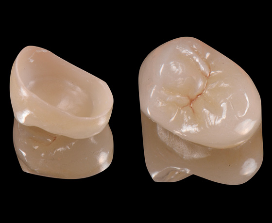 Full-contour zirconia crown View 2