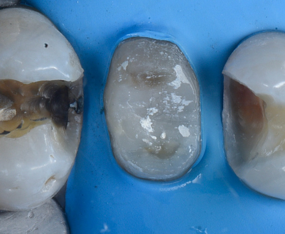 First molar amalgam and first premolar composite removal