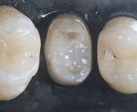 Upper molar and upper premolar partial restorations