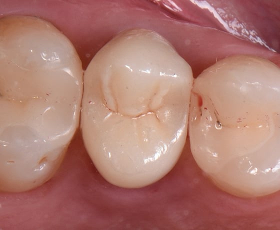 Result after cementation