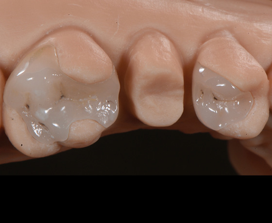 CAD/CAM lithium disilicate partial restorations