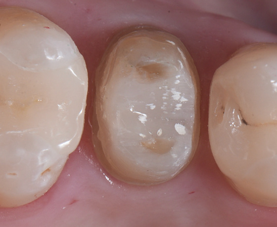 Full-contour zirconia crown View 1