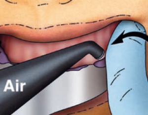 Measures facilitating removal of the impression from the mouth