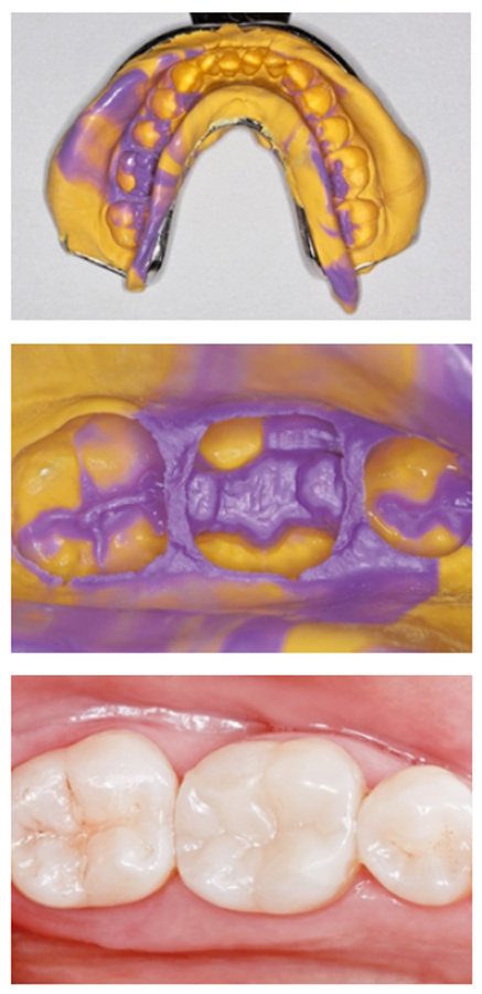 Impression removed from the mouth
