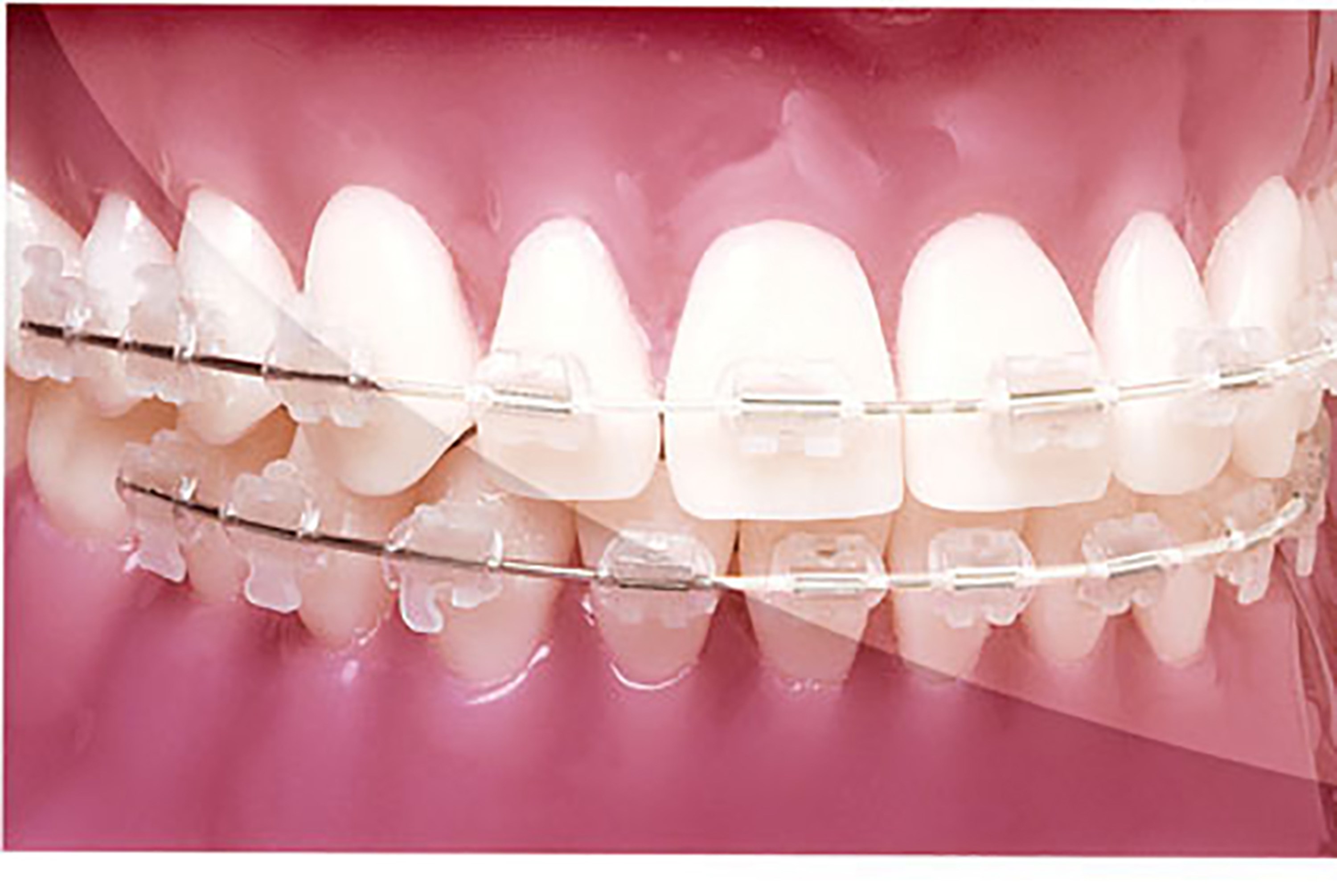 A set of braces sitting on some clean white teeth, the length of the Curve of Spee for this archwire has been dyed white so as to blend in with the patient's teeth.