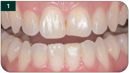 Pre-restorative photos post-orthodontics. 