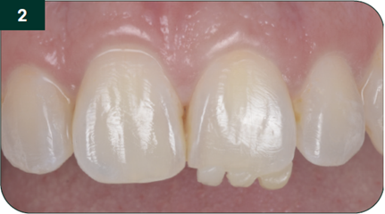 Composite shade try-ins