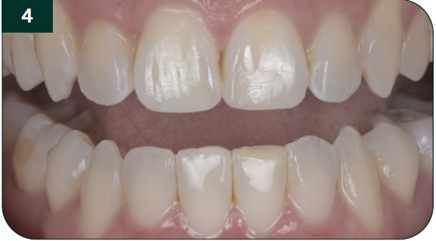 Composite placement complete