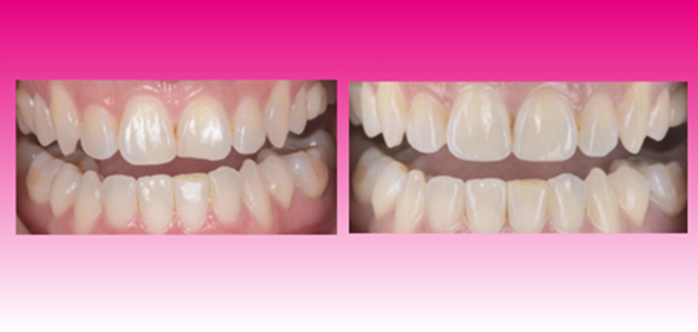 Aesthetics with 3M™ Filtek™ Easy Match Universal Restorative image