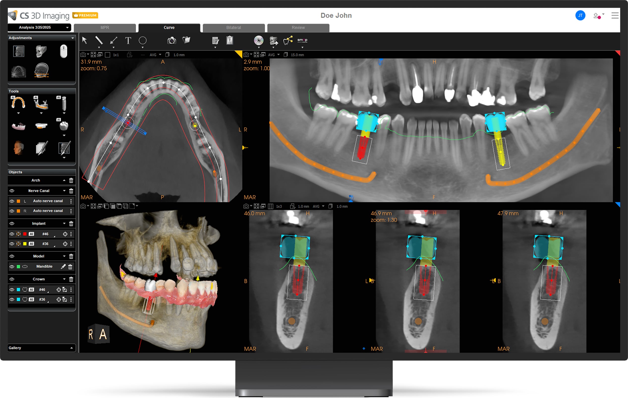 CS 3D Imaging Premium MPR View for Implant planning