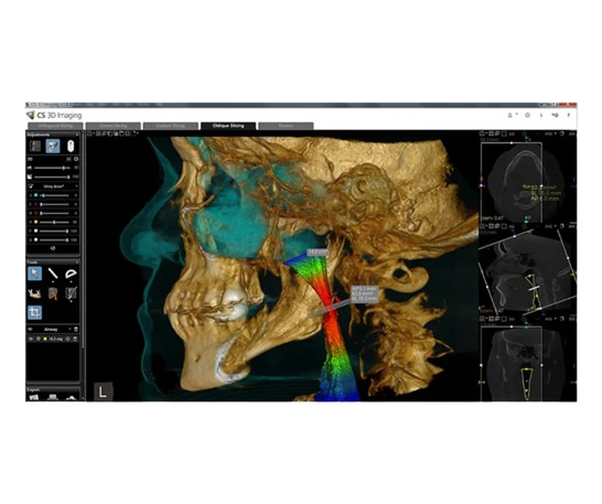 A render from CS Airway, its colour coding makes it easy to see obstructions in the upper airway