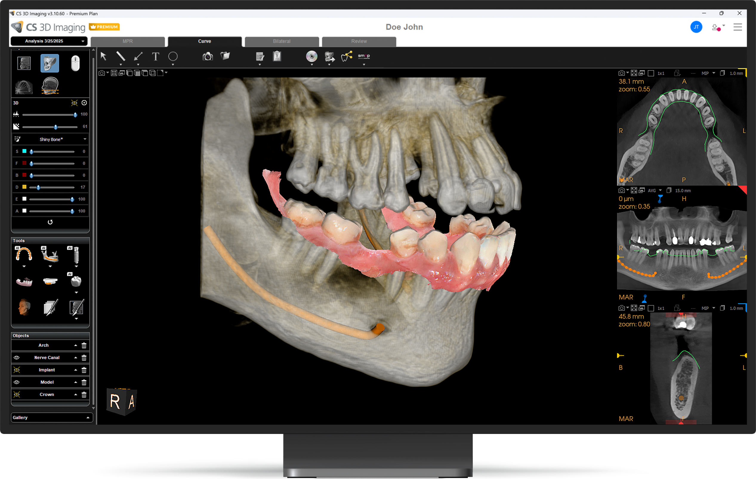 A monitor in a white room, the monitor displays a CS 3D Imaging Premium view