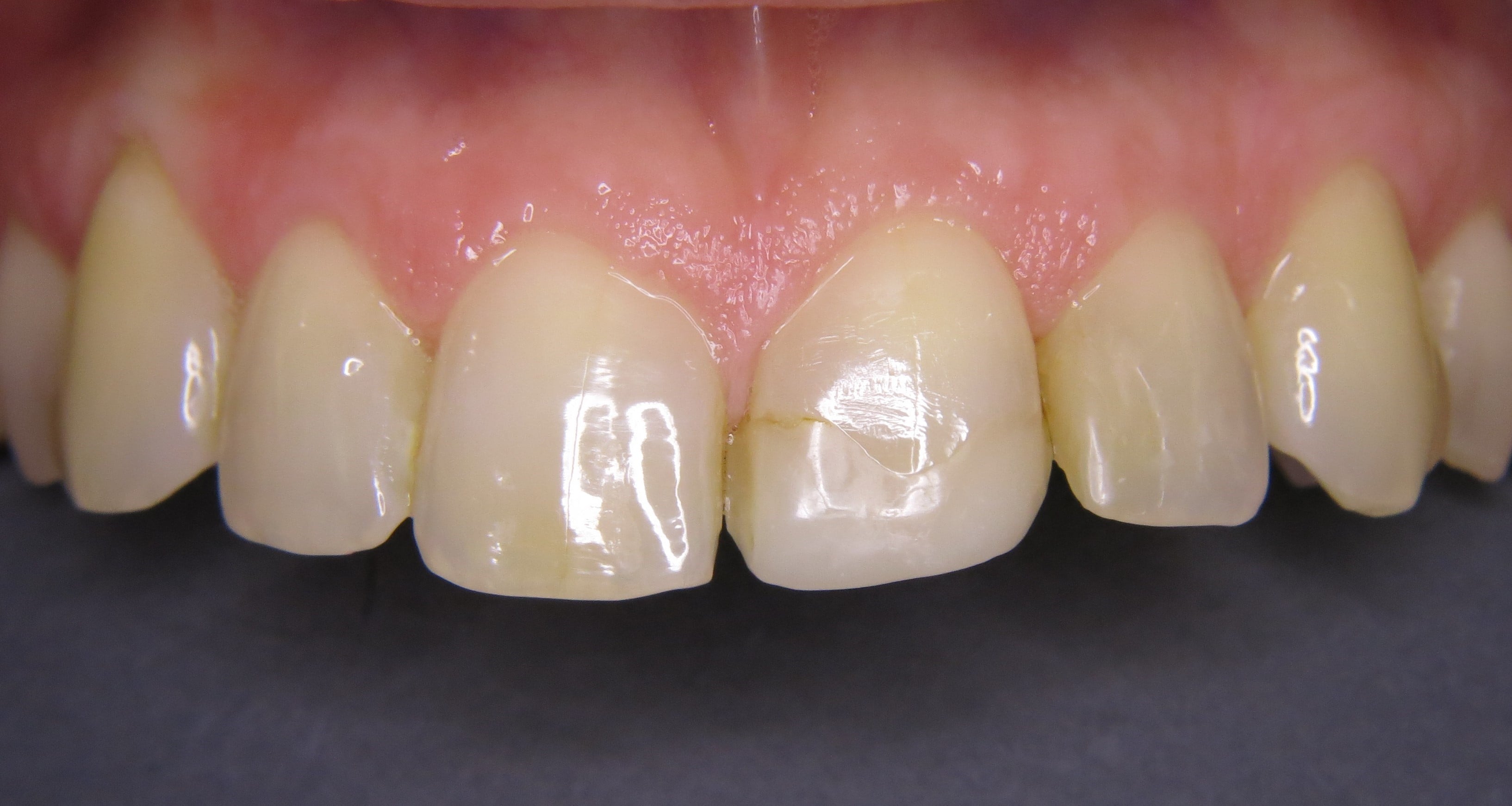 A discoloured & damaged tooth