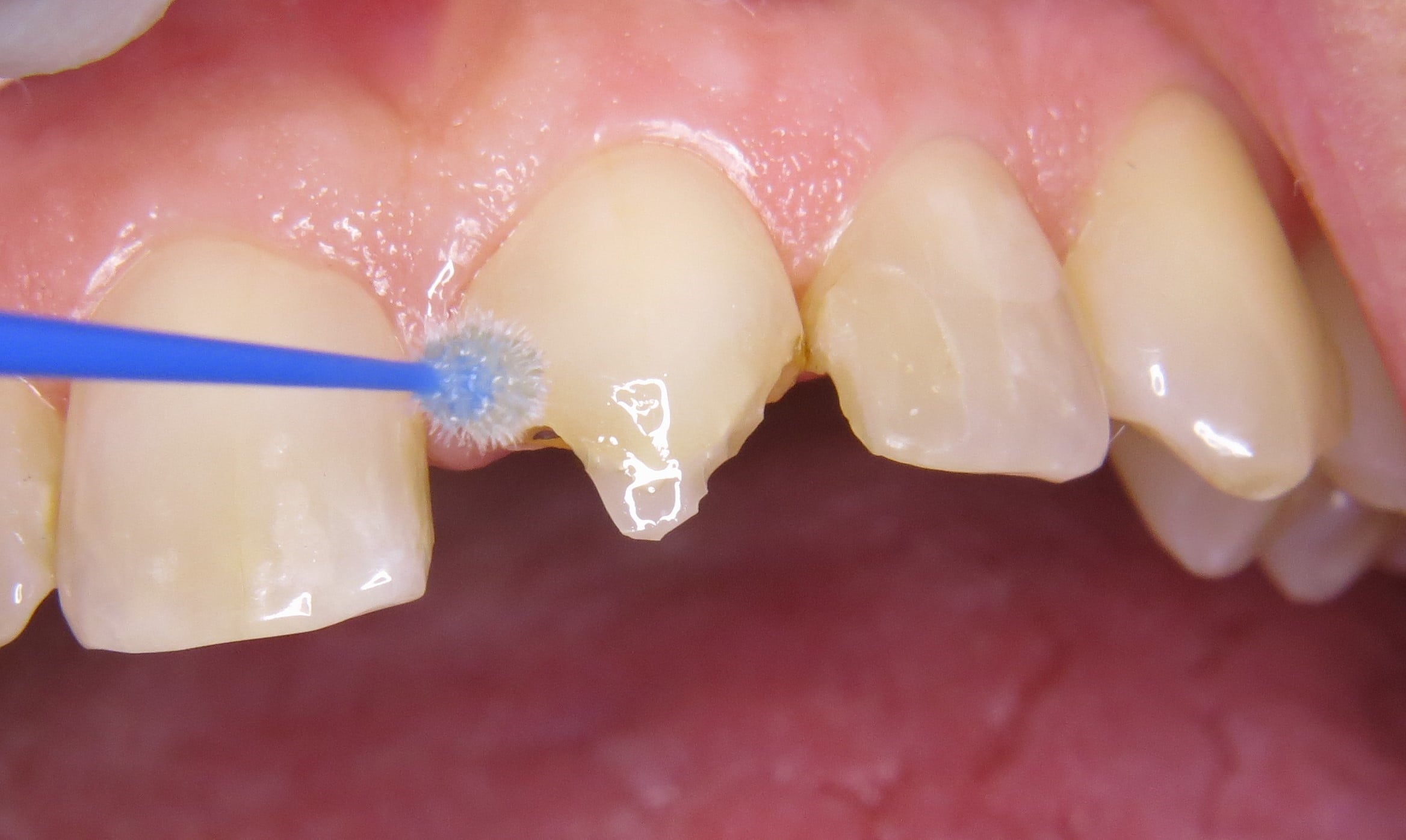 The application of Admira Fusion 5 resotrative