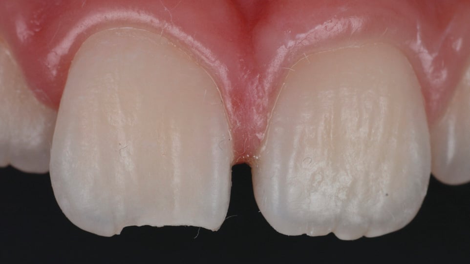 Image of tooth restoration with flowable composite