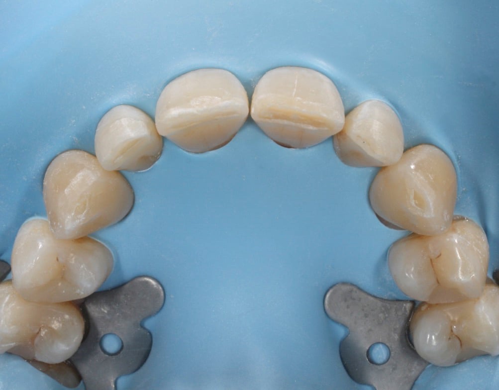 A rubber dam clamped firmly over a set of teeth
