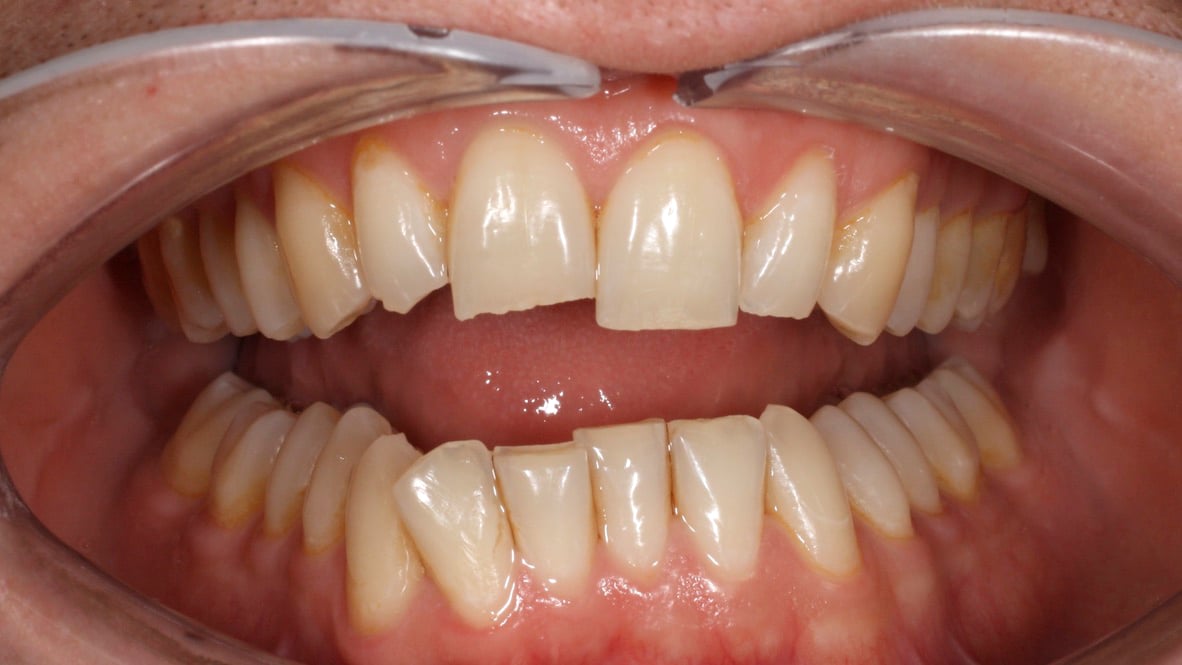 Worn and mis-algined teeth.