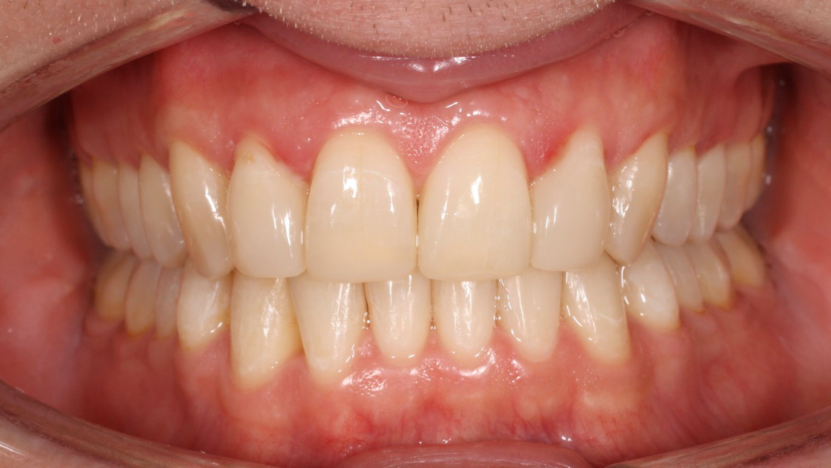 A rehydrated and straightened set of teeth. Much less discoloured than their earlier images.