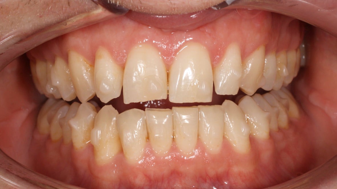 The same teeth as above but after 26 aligners have repositioned the teeth to create space around the laterals