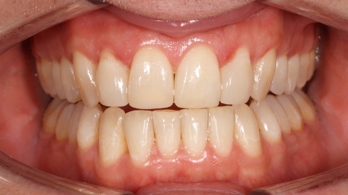 A rehydrated and straightened set of teeth. Much less discoloured than their earlier images.