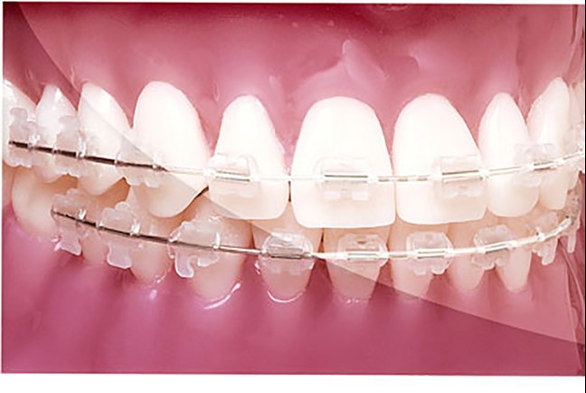 Reverse Curve G4 NiTi Tooth-Coloured .019x.025 Upper