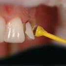 OptraStick Refill 